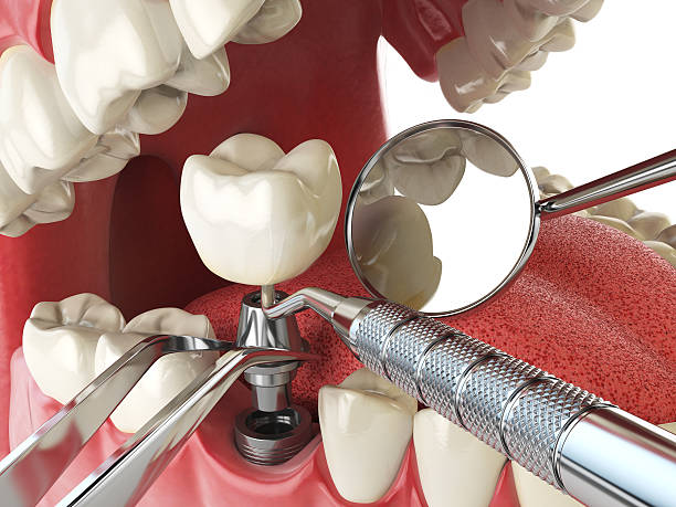 Best Emergency Root Canal Treatment in Towson, MD